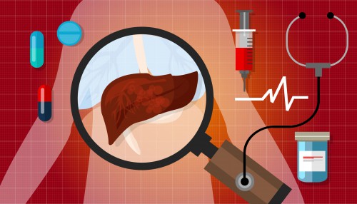 liver cancer disease illustration human anatomy sick unhealthy treatment medical vector